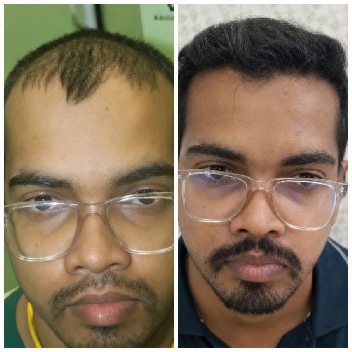 نتائج زراعة الشعر قبل وبعد في عيادات Vplant Speciality Clinics، كثافة شعر محسنة