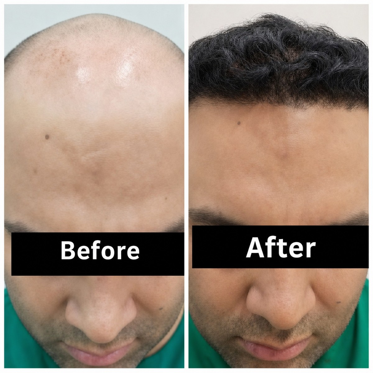 نتائج زراعة الشعر قبل وبعد في Vplant Speciality Clinics، استعادة خط الشعر