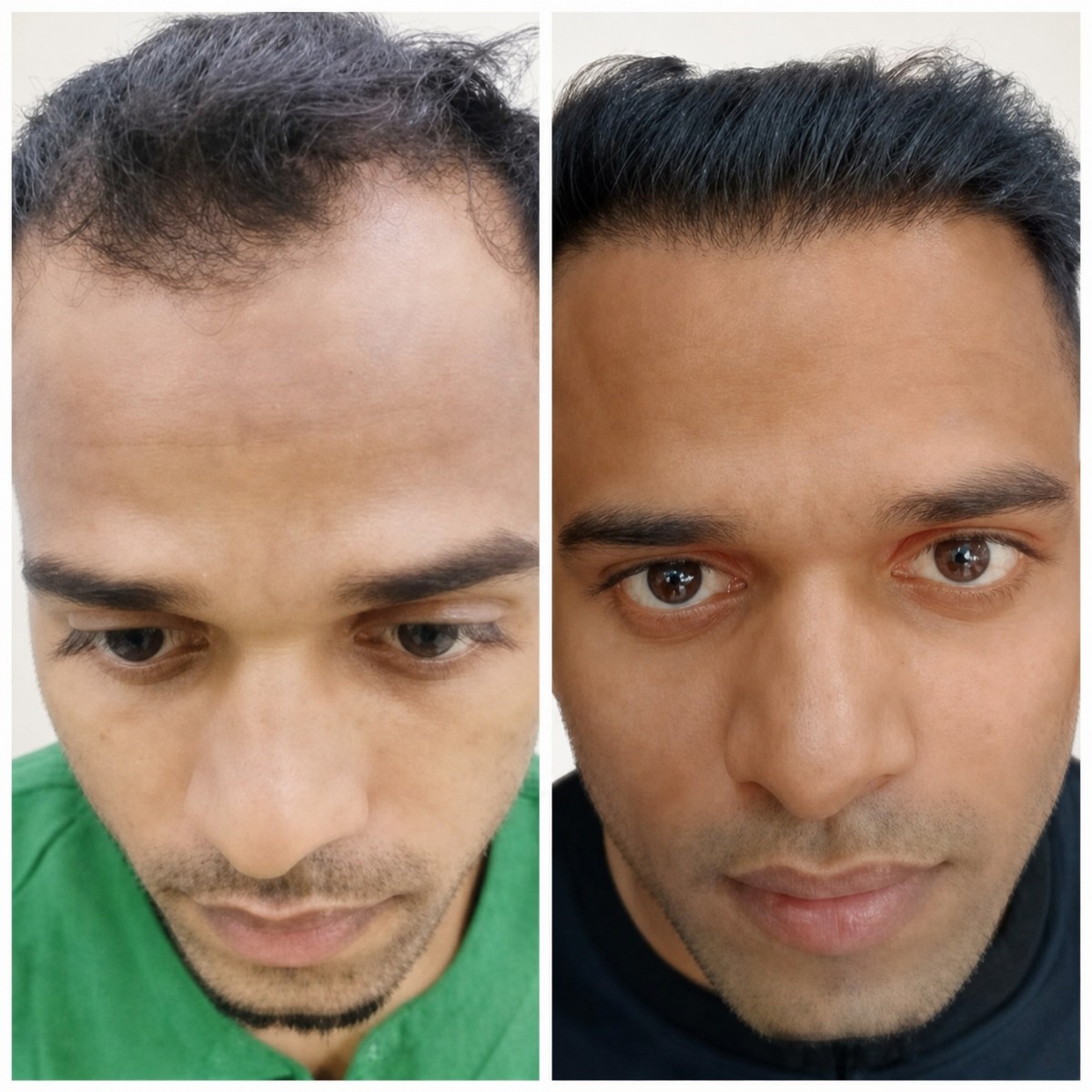 نتائج زراعة الشعر قبل وبعد في عيادات Vplant، استعادة خط الشعر الأمامي