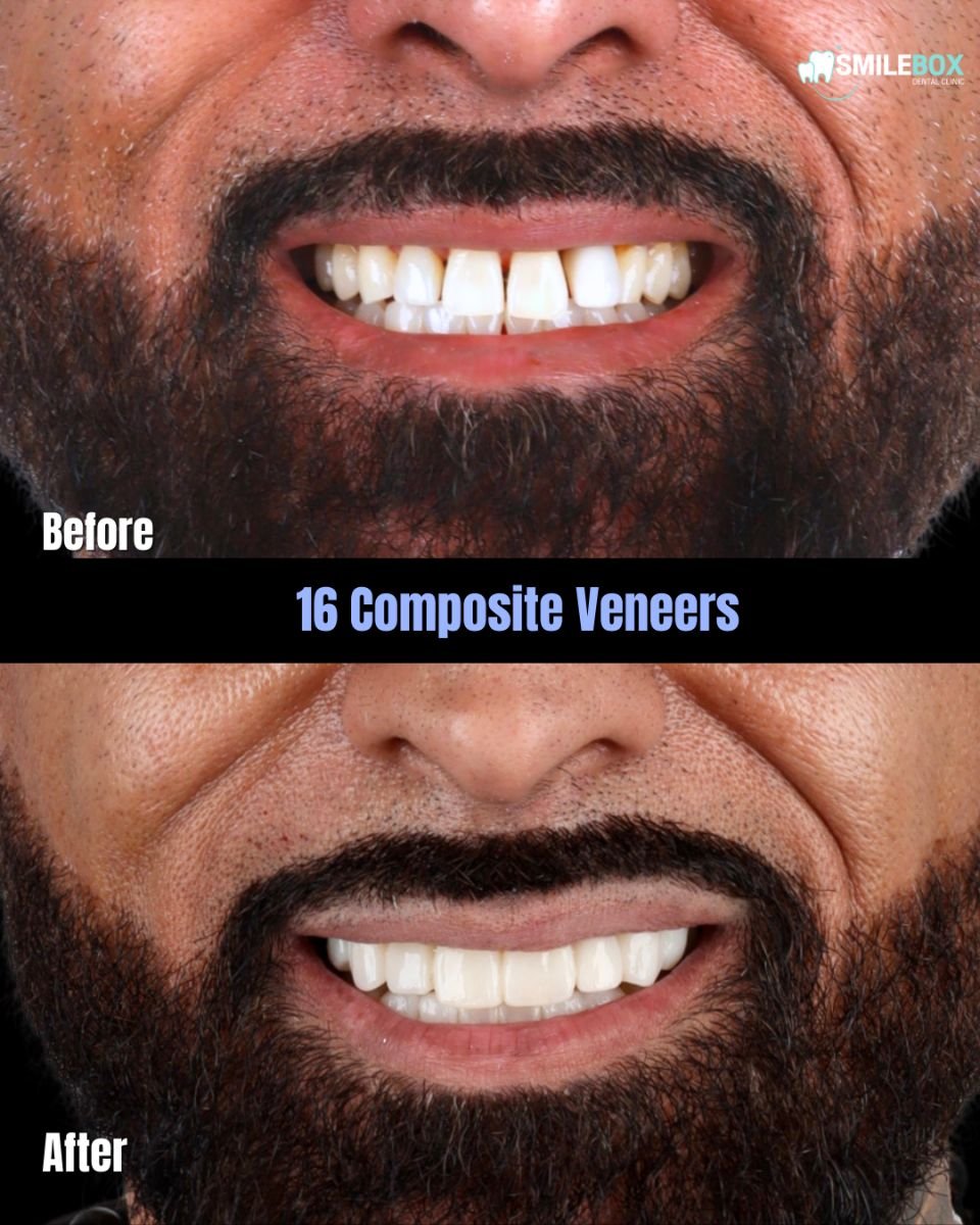 نتائج قبل وبعد 16 قشرة تجميلية مركبة في SmileBox Dental Clinic - Thonglor, Sukhumvit
