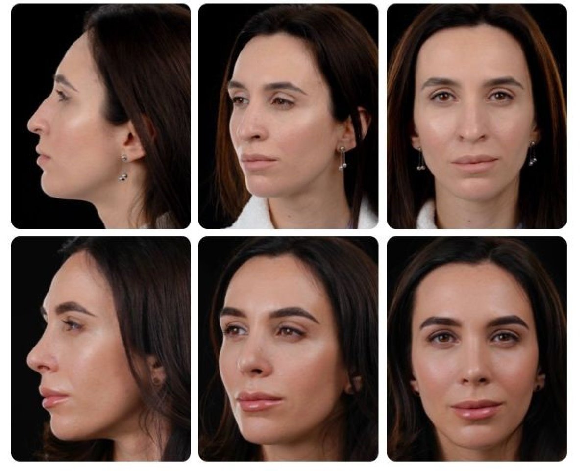 Результаты ринопластики до и после в Yurchenko Plastic Surgery Team Kyiv, коррекция носа