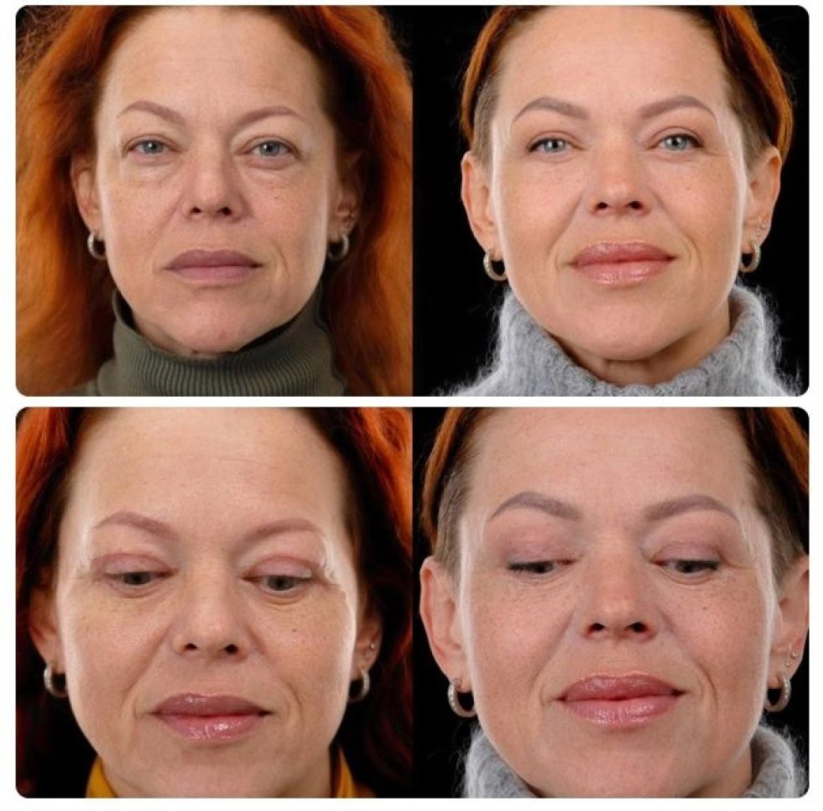 Facelift before and after results at Yurchenko Plastic Surgery Team Kyiv, facial rejuvenation