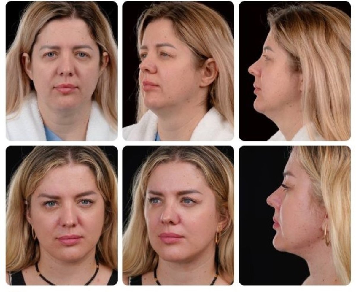 نتائج شد الوجه قبل وبعد في Yurchenko Plastic Surgery Team Kyiv، تجديد شباب الوجه