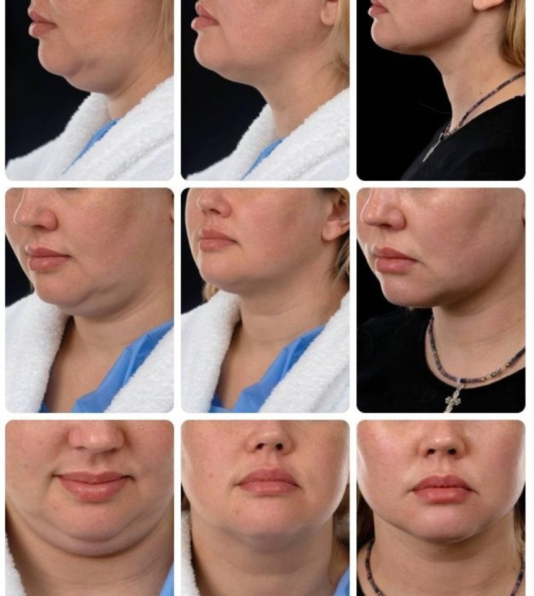 Результаты до и после фейслифтинга в Yurchenko Plastic Surgery Team Kyiv, видимый лифтинг шеи