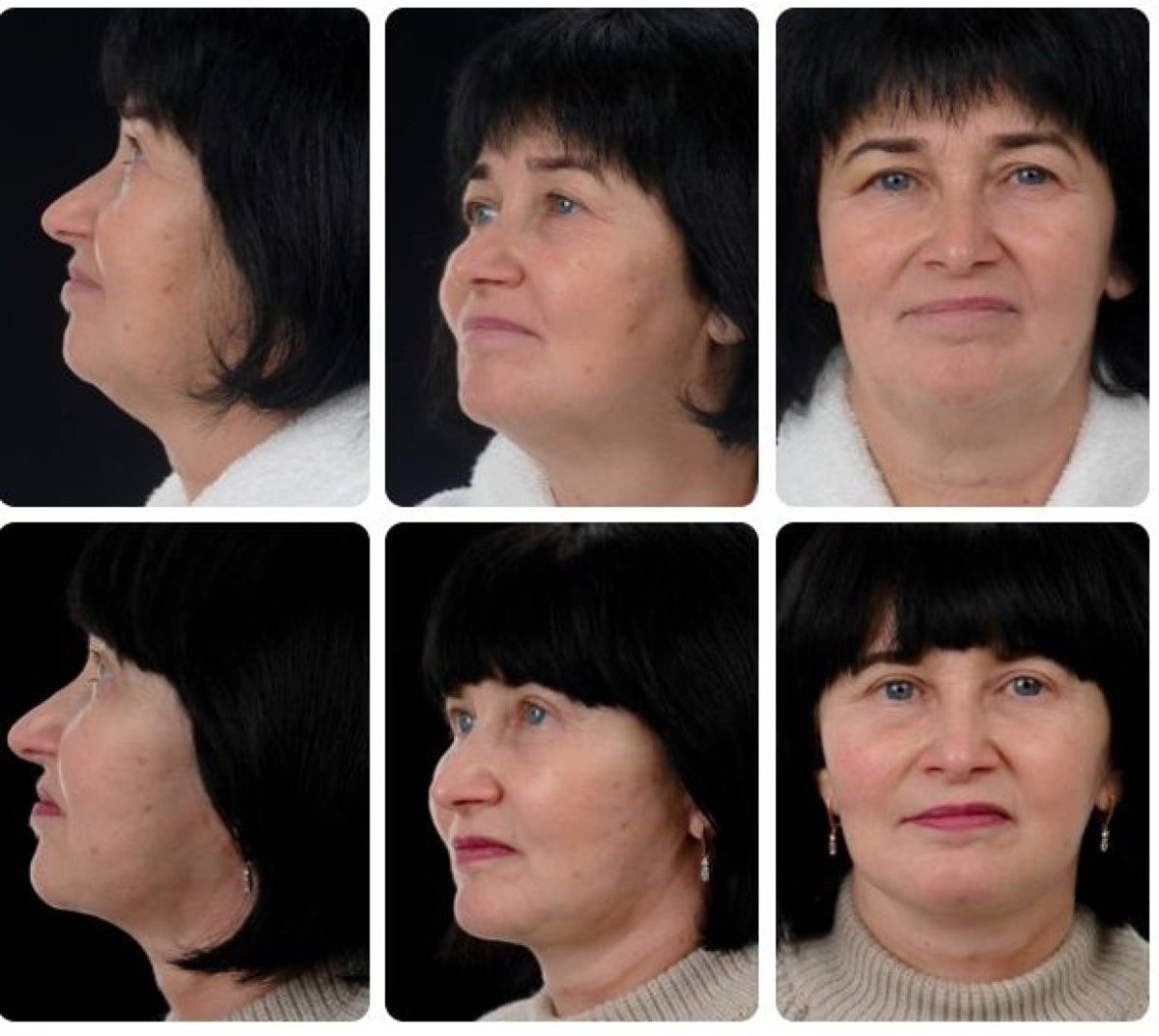 Facelift before and after results at Yurchenko Plastic Surgery Team Kyiv, facial rejuvenation