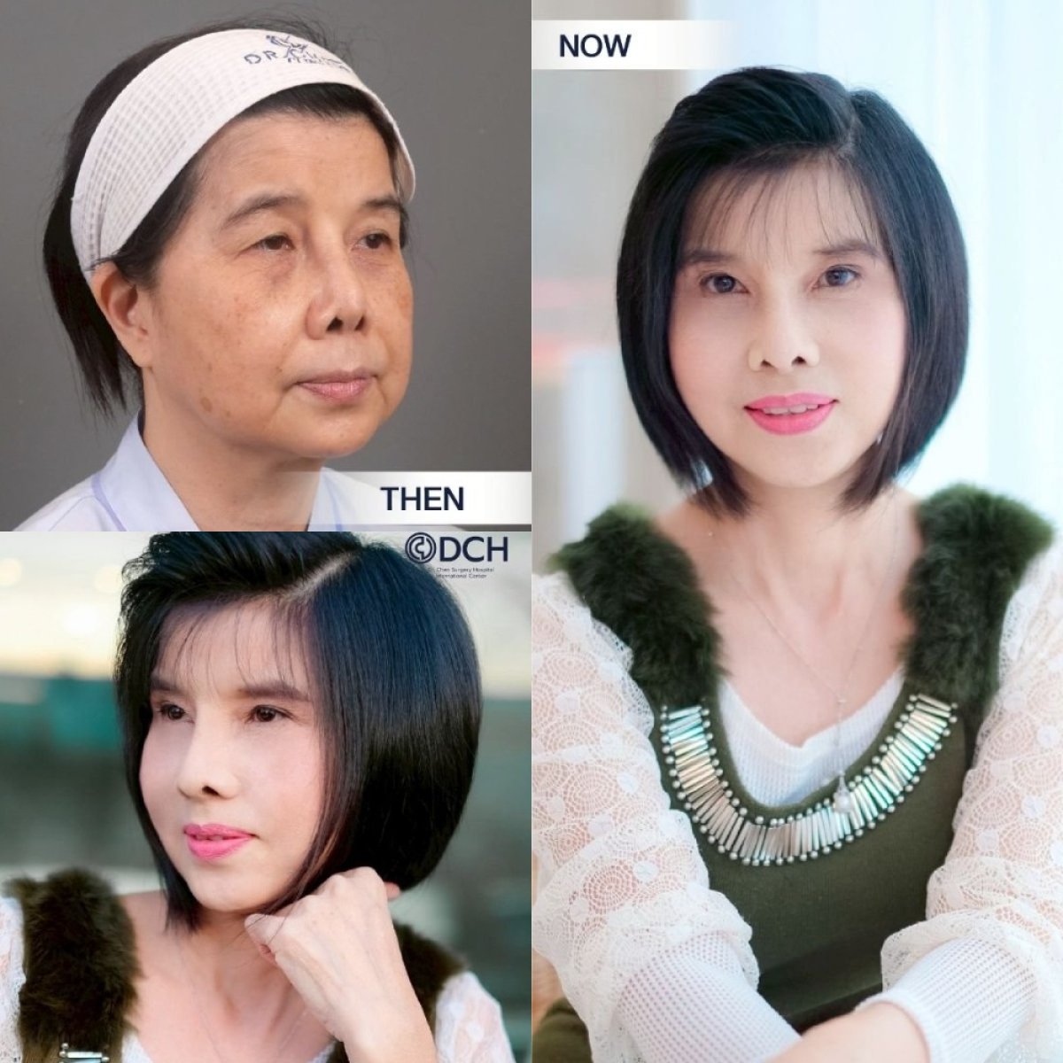 Resultados antes y después de lifting de cuello en Dr. Chen Surgery Hospital International Center