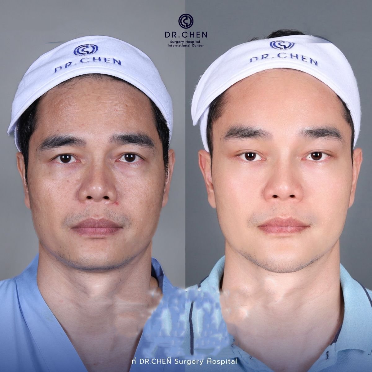 Результат до и после лифтинга нитями с гиалуроновой кислотой в Dr. Chen Surgery Hospital