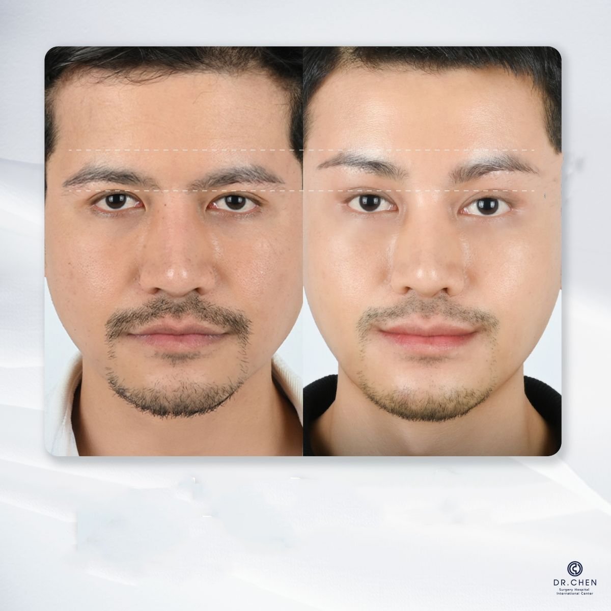 Resultado antes y después de lifting con hilos de ácido hialurónico en Dr. Chen Surgery Hospital