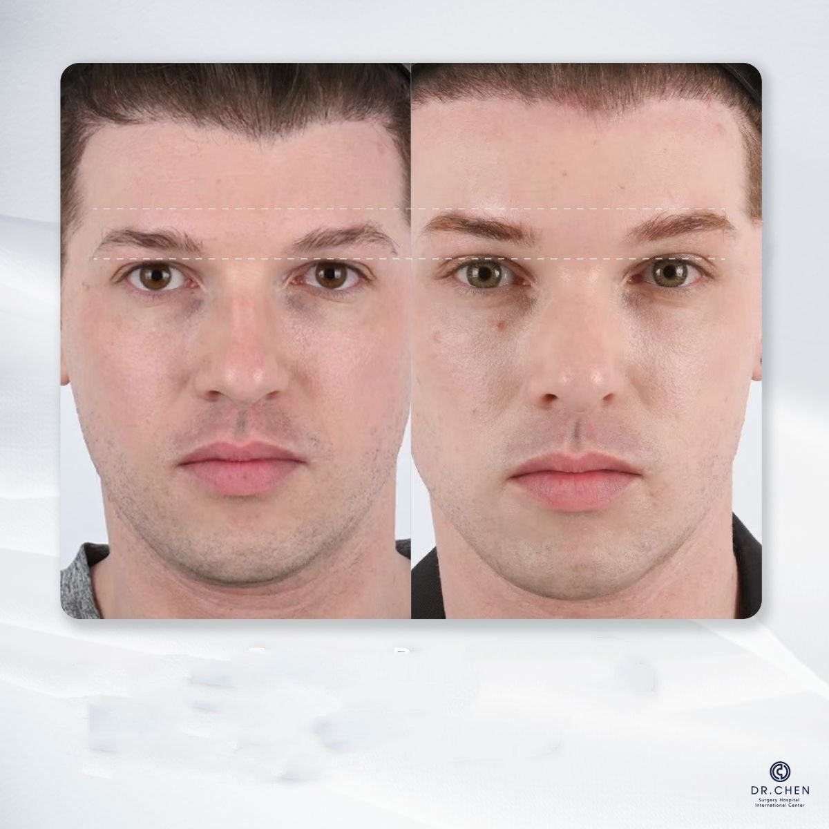 Результат до и после лифтинга нитями с гиалуроновой кислотой в Dr. Chen Surgery Hospital