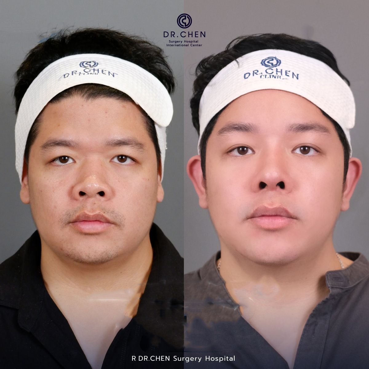 Resultado antes y después de lifting con hilos de ácido hialurónico en Dr. Chen Surgery Hospital