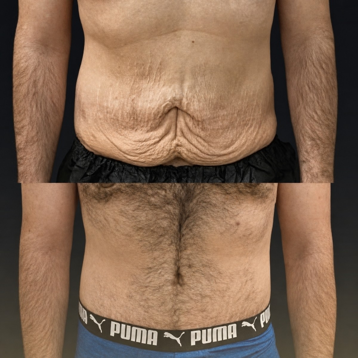 Before and after tummy tuck and liposuction results at Memorial Şişli Hospital, flatter abdomen