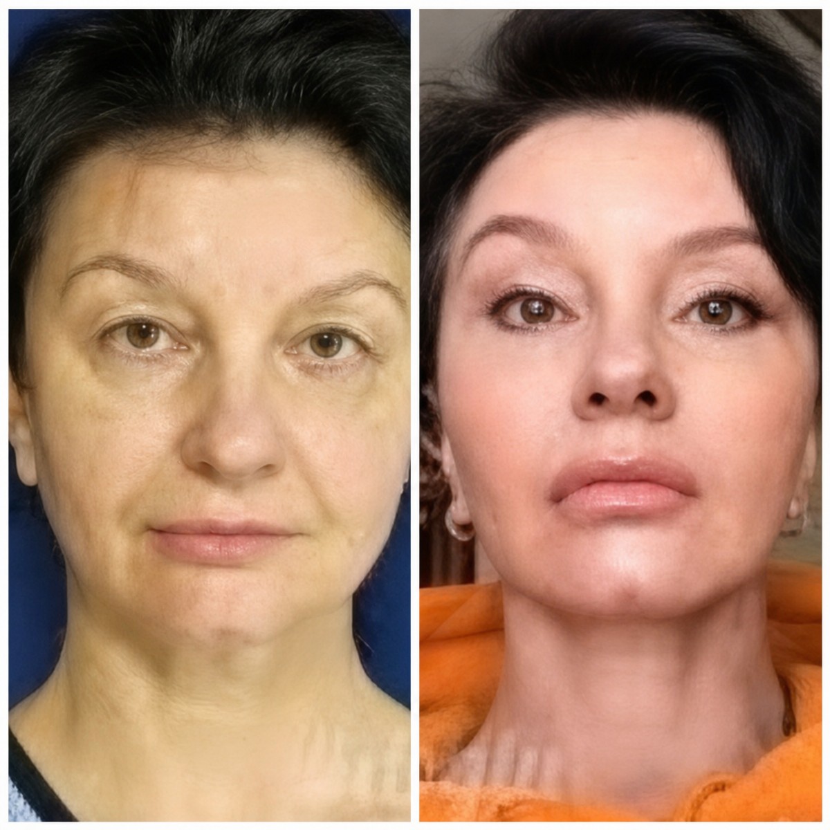 Resultados de lifting facial antes y después en Memorial Ataşehir Hospital, rejuvenecimiento visible
