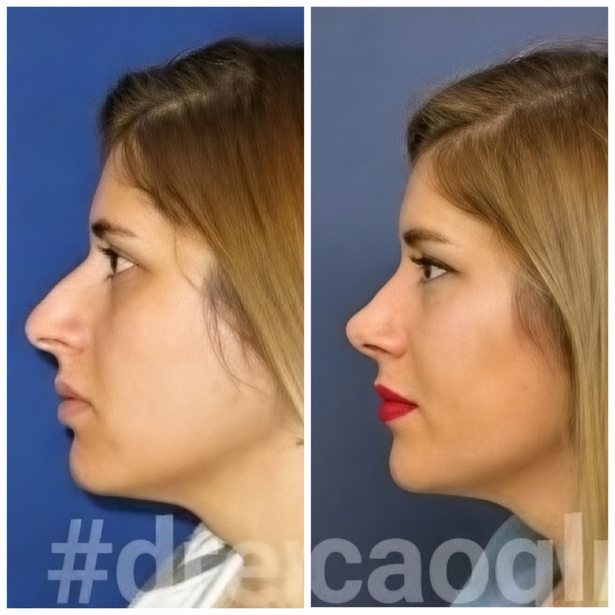 Resultados de rinoplastia antes y después en Memorial Ataşehir Hospital, remodelación nasal