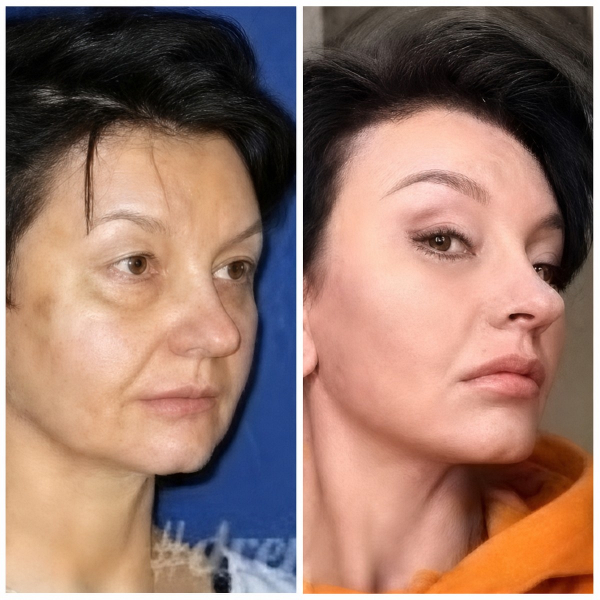 Resultados de lifting facial antes y después en Memorial Ataşehir Hospital, rejuvenecimiento visible
