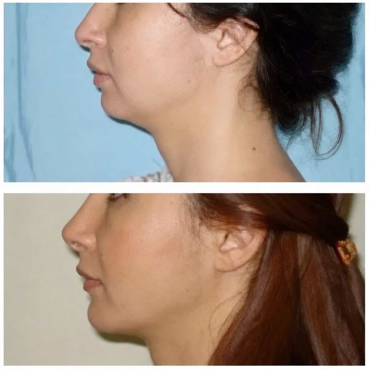 Resultados de lifting facial antes y después en Memorial Ataşehir Hospital, mejora de la mandíbula