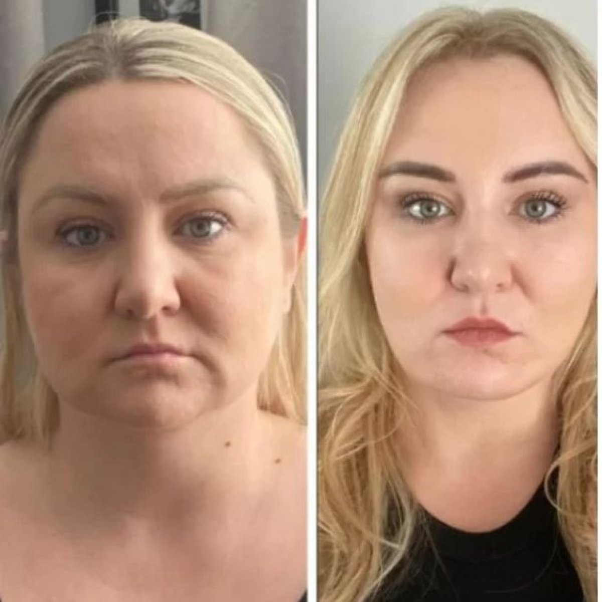 Facelift before and after results at Memorial Ataşehir Hospital – visible facial rejuvenation