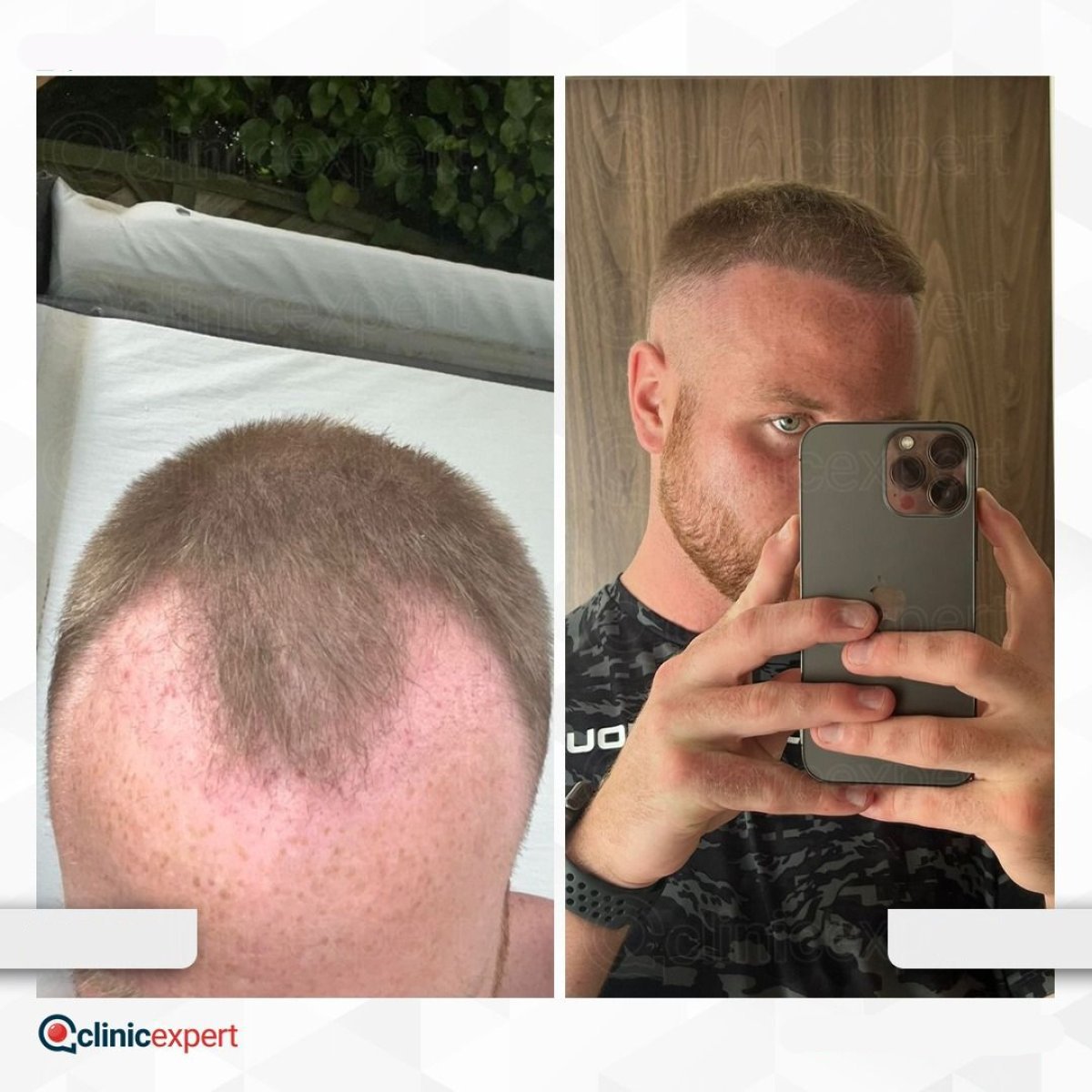 نتائج زراعة الشعر قبل وبعد في CE International Hospital، استعادة خط الشعر للرجال