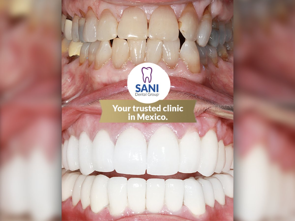 نتائج قبل وبعد الفينير في Sani Dental Group Main Clinic – تحول الابتسامة