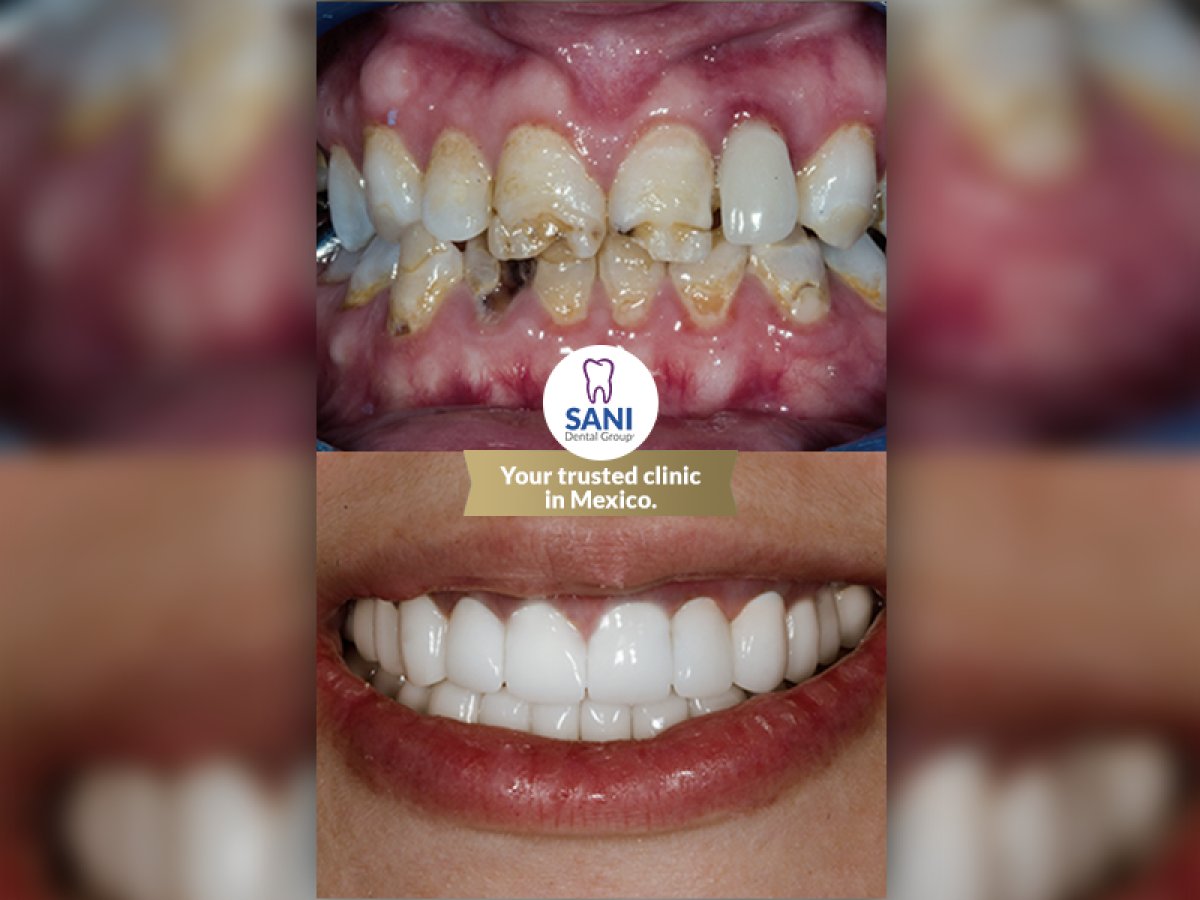 Before and after dental prosthetics installation at Sani Dental Group Main Clinic, smile result
