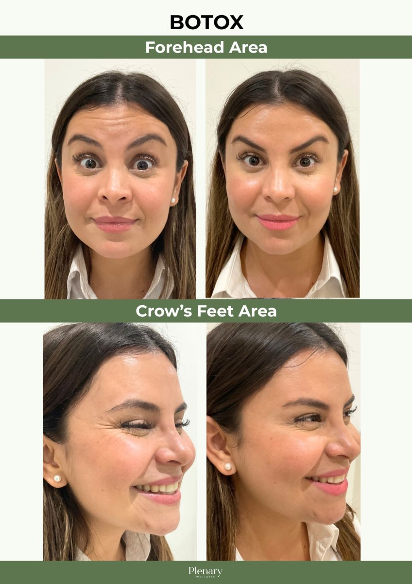 Resultados de inyecciones de botox en Plenary Wellness: frente y patas de gallo más suaves