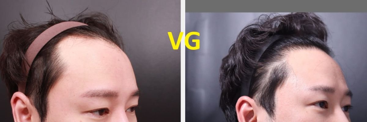 نتائج زراعة الشعر FUE قبل وبعد في VG Plastic Surgery، كثافة خط الشعر المحسنة