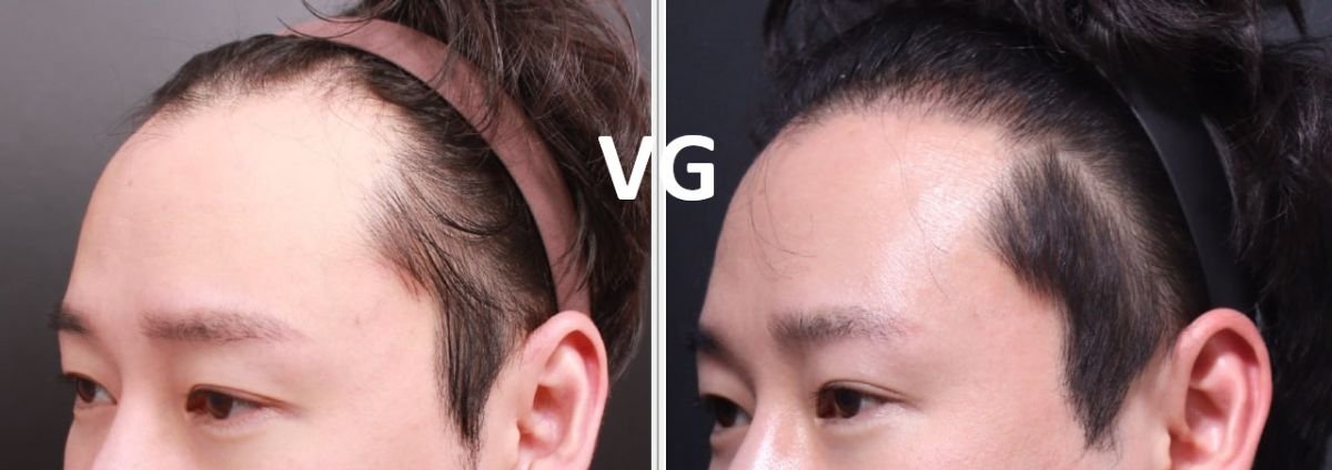 Результат пересадки волос FUE до и после в VG Plastic Surgery, улучшенная линия роста волос