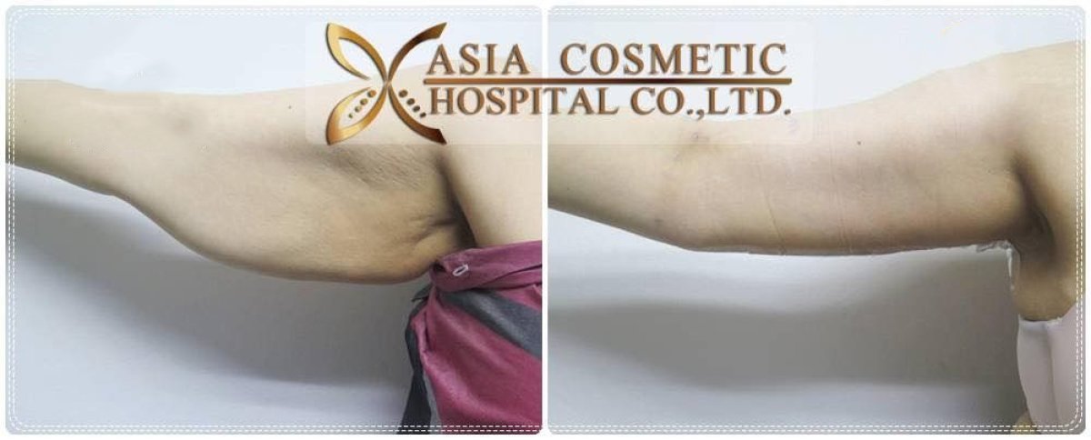 Before and after arm lift results at Asia Cosmetic Hospital, improved arm contour after brachioplasty
