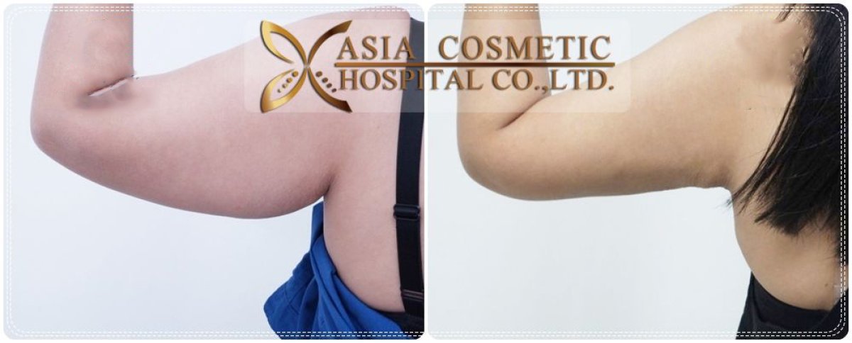 Before and after arm lift (brachioplasty) results at Asia Cosmetic Hospital, slimmer arms