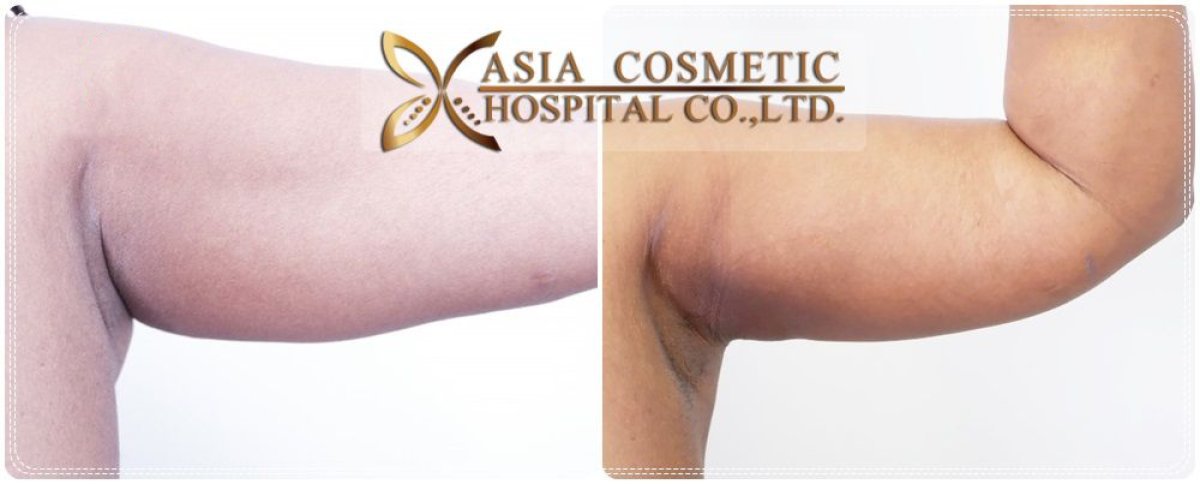 Before and after arm lift results at Asia Cosmetic Hospital, improved arm contour after brachioplasty