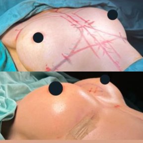 Standard Breast augmentation with Motiva® GlutealArmonic® breast implants All Included - photo 5