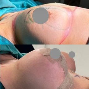 Standard Breast augmentation with Motiva® GlutealArmonic® breast implants All Included - photo 4
