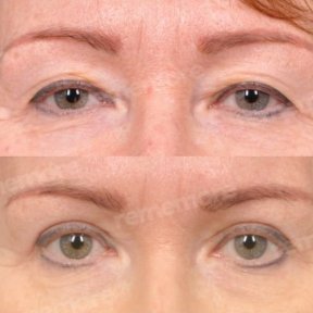 Standard Blepharoplasty (Eyelid correction) with All Included