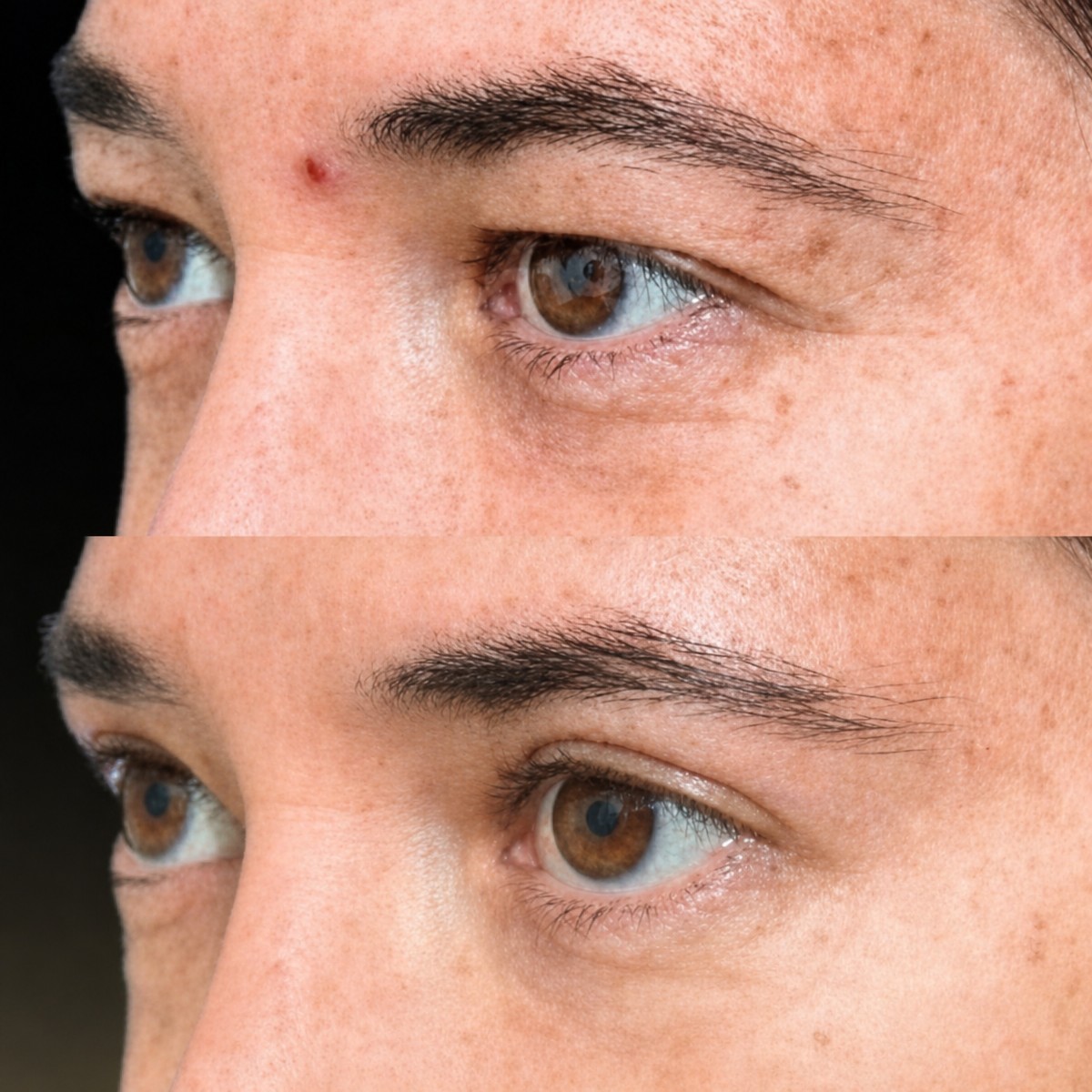 Before and after blepharoplasty results at Memorial Şişli Hospital, eyelid correction outcome