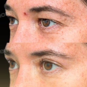 Standard Blepharoplasty (Eyelid correction) with All Included - photo 6