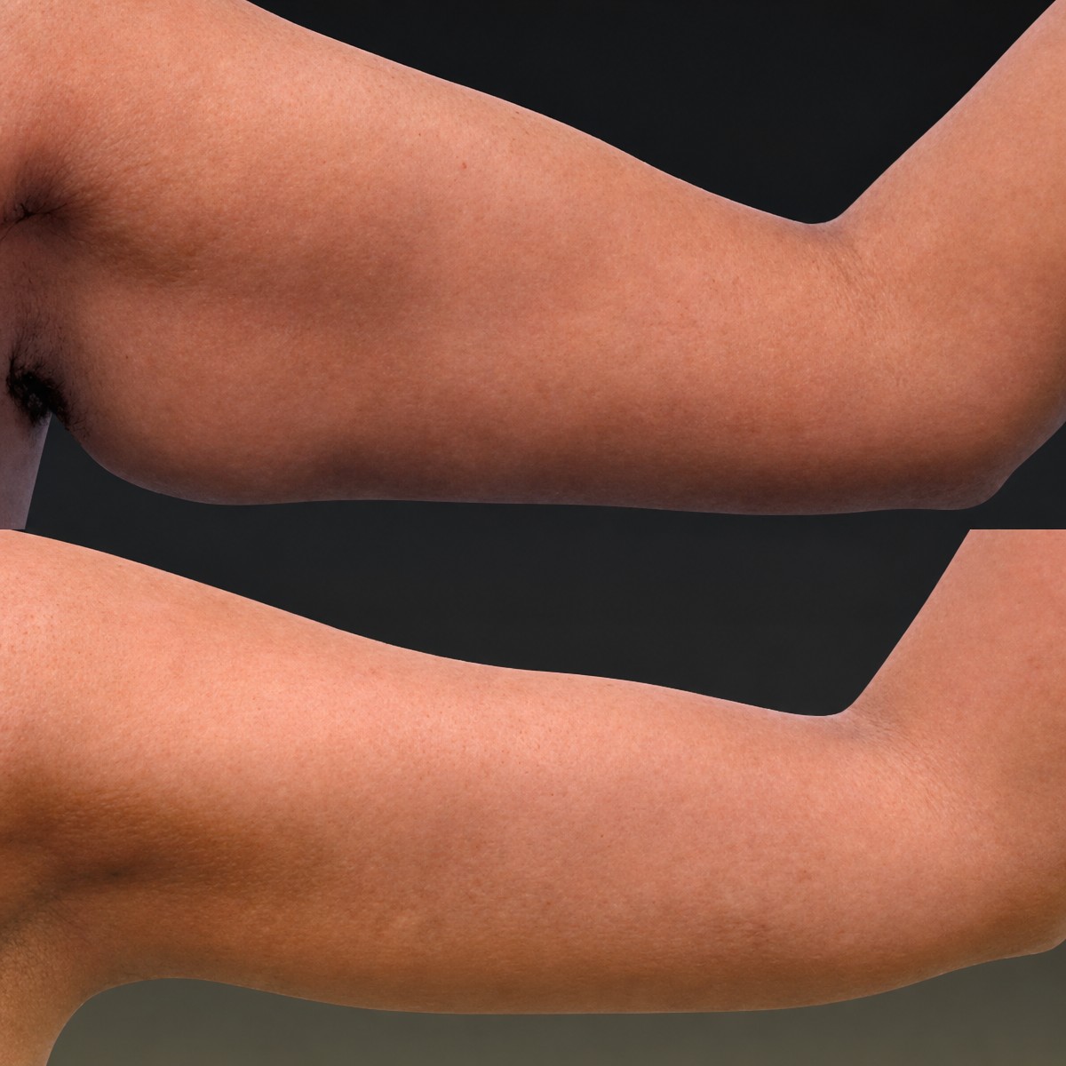 Before and after arm lift results at Memorial Şişli Hospital, improved arm contour after brachioplasty