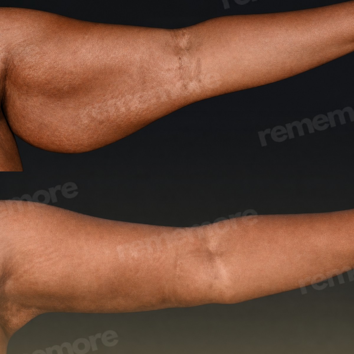 Before and after arm lift (brachioplasty) results at Memorial Şişli Hospital, improved contour