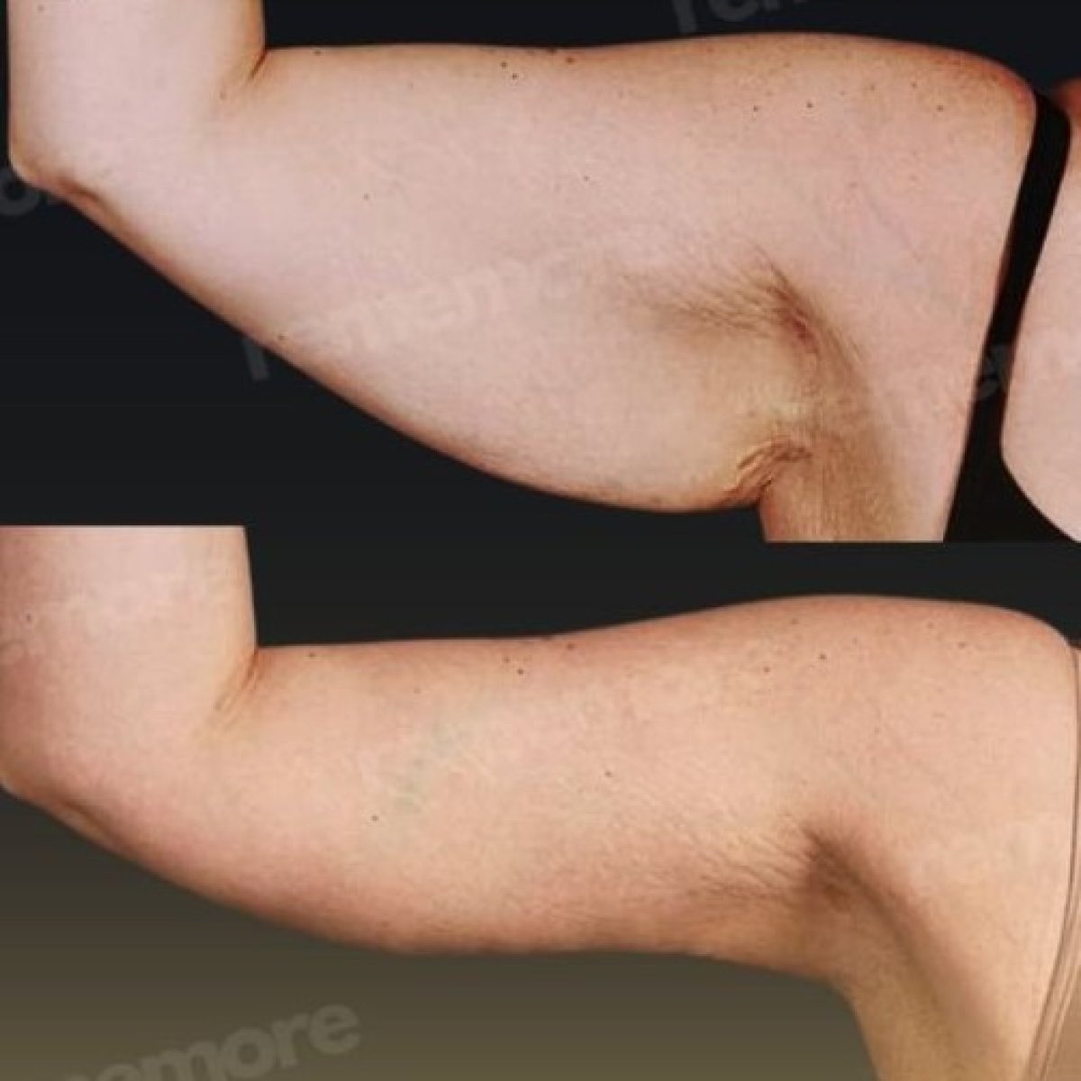 Before and after arm lift results at Memorial Şişli Hospital, improved upper arm contour