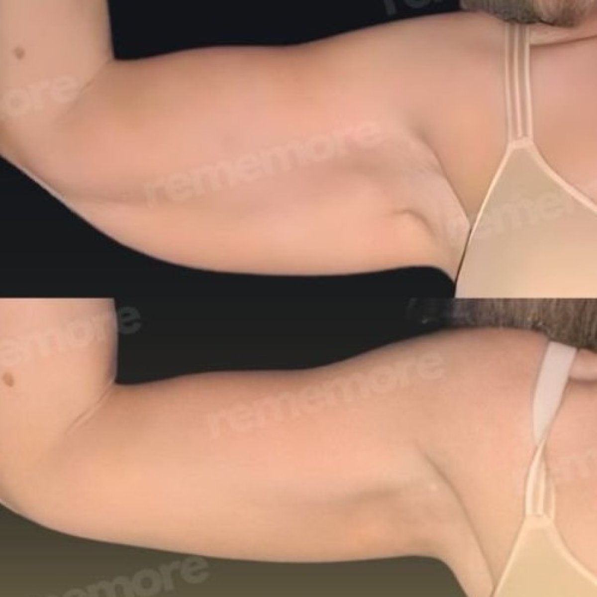 Before and after arm lift results at Memorial Şişli Hospital, improved upper arm contour