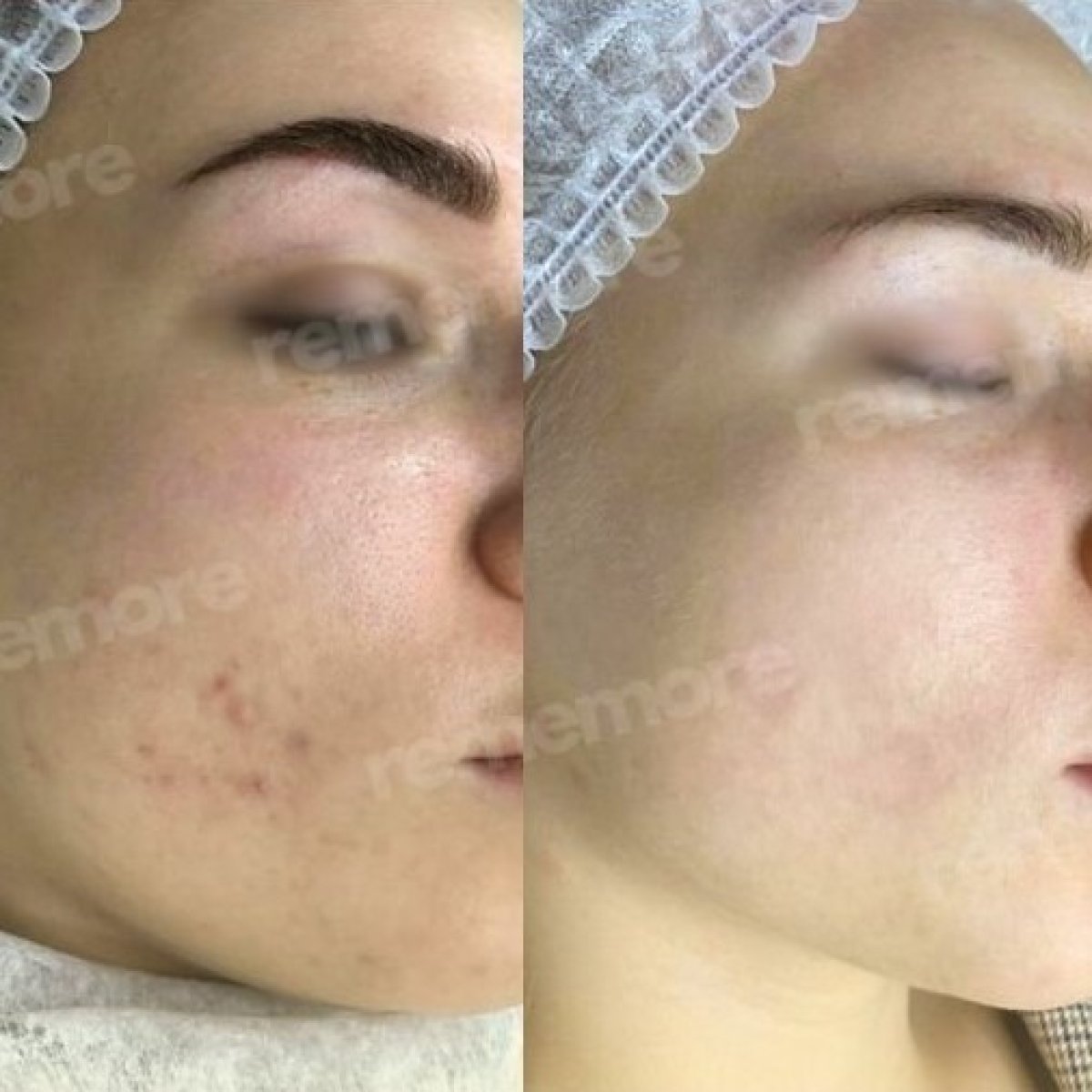 Resultados antes y después de peeling químico en Memorial Bahçelievler Hospital, piel mejorada