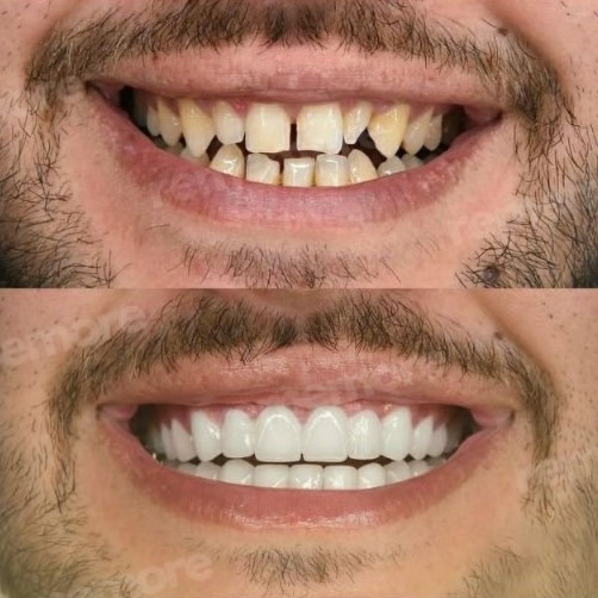 Before and after denture results at Memorial Bahçelievler Hospital, improved smile aesthetics
