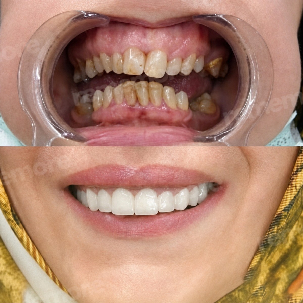 Before and after denture results at Memorial Bahçelievler Hospital, smile restoration