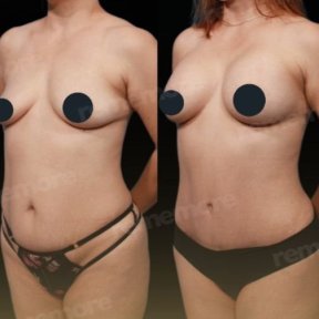 Standard Tummy tuck with All Included - photo 5