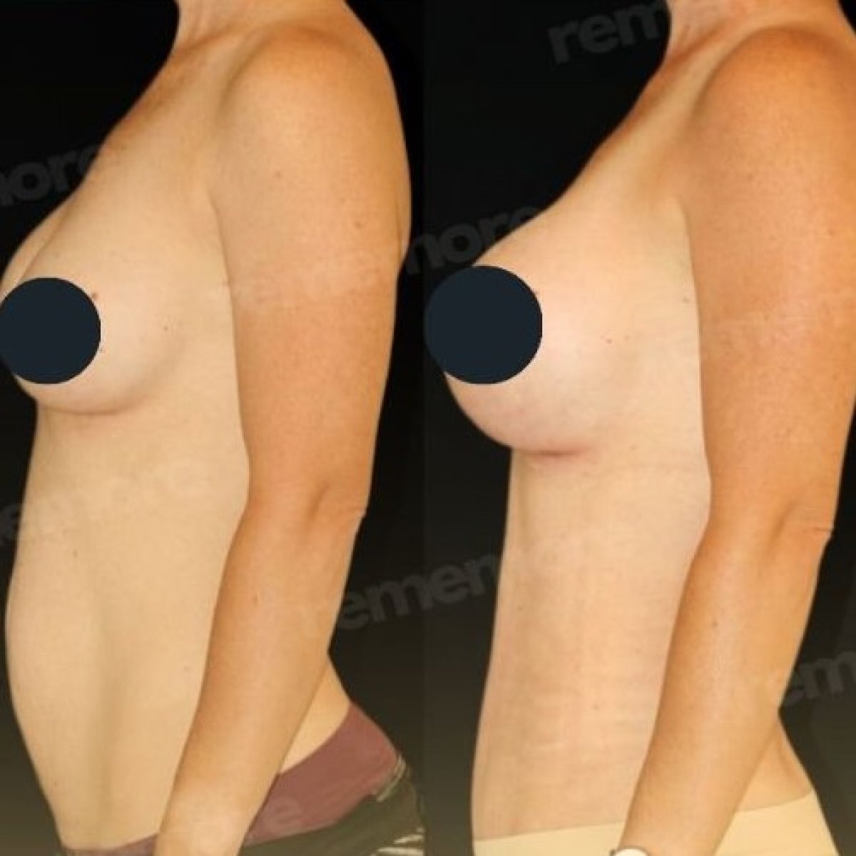 Before and after tummy tuck results at Memorial Bahçelievler Hospital, improved abdomen contour