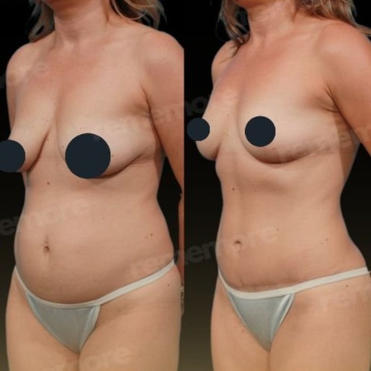 Before and after tummy tuck results at Memorial Bahçelievler Hospital, improved abdomen contour