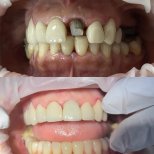 Before and after Dental Implant photos by Dr. 