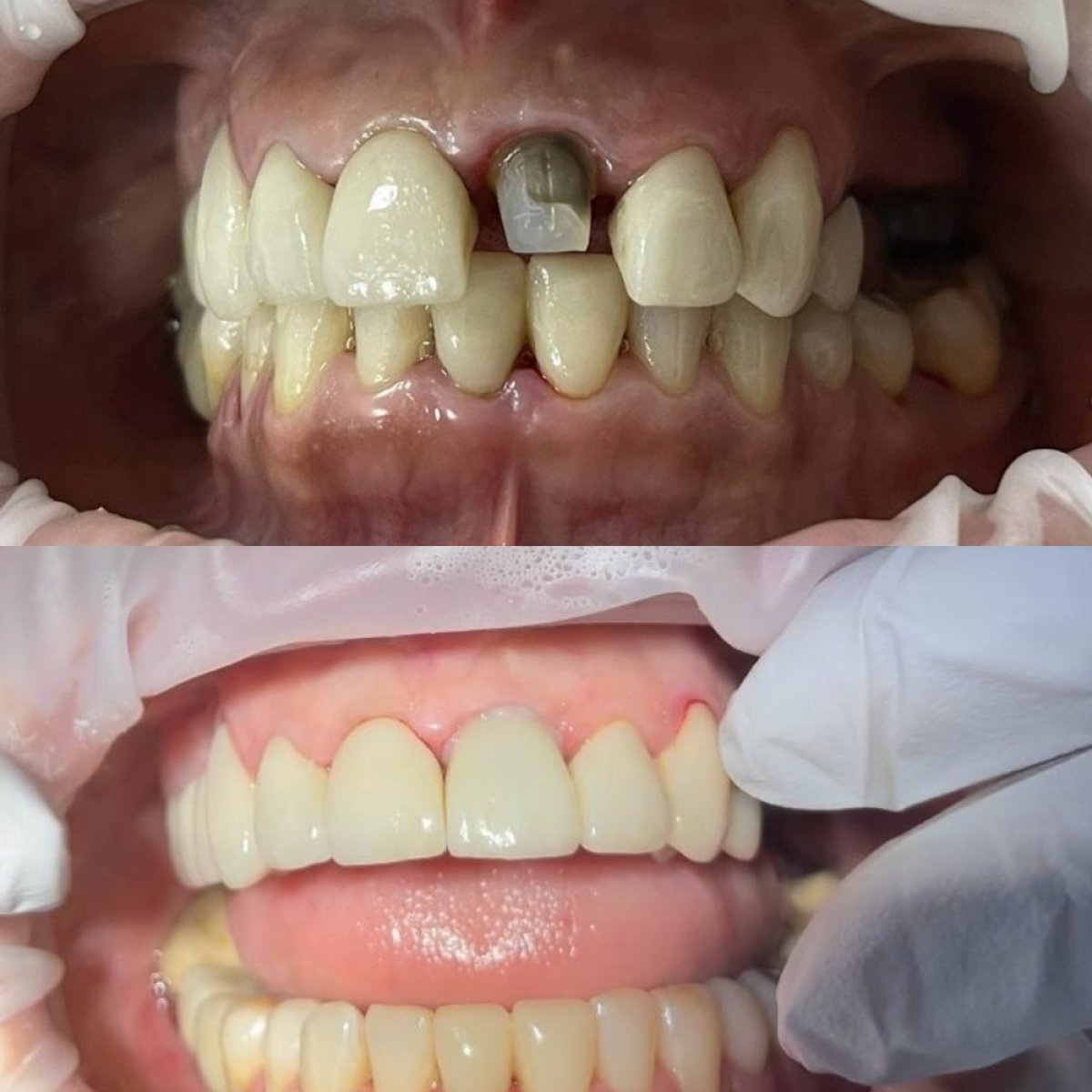 Resultados antes y después de coronas de porcelana en Teethsavers Dental Clinic, sonrisa mejorada