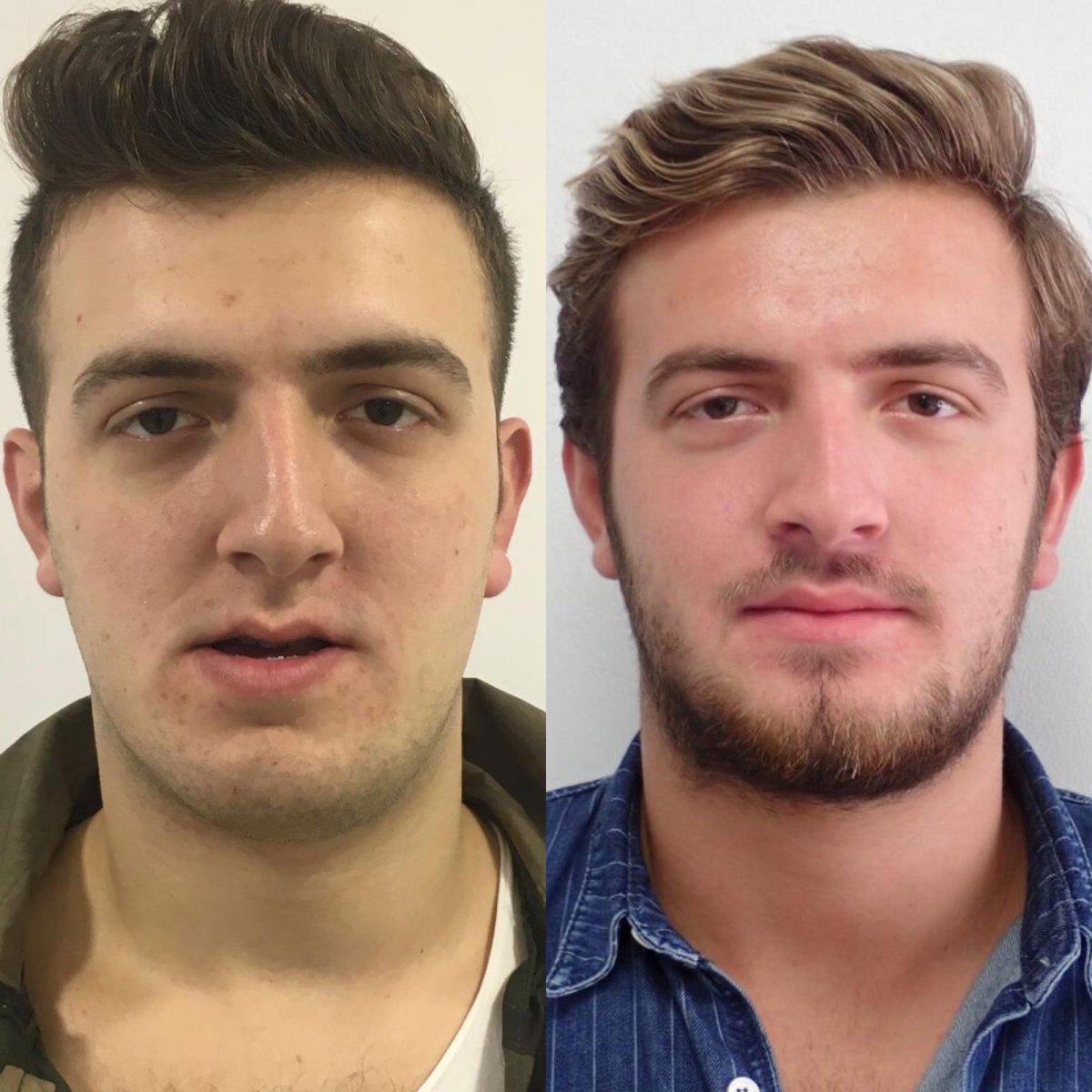 Efekty przed i po chirurgii ortognatycznej w Dentavie Istanbul Dental Clinic, poprawiony profil twarzy