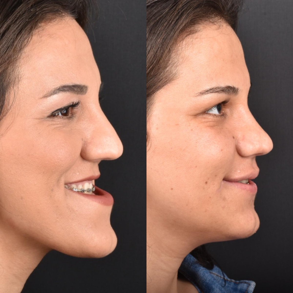 Orthognathic surgery before and after results at Dentavie Istanbul Dental Clinic, jaw alignment