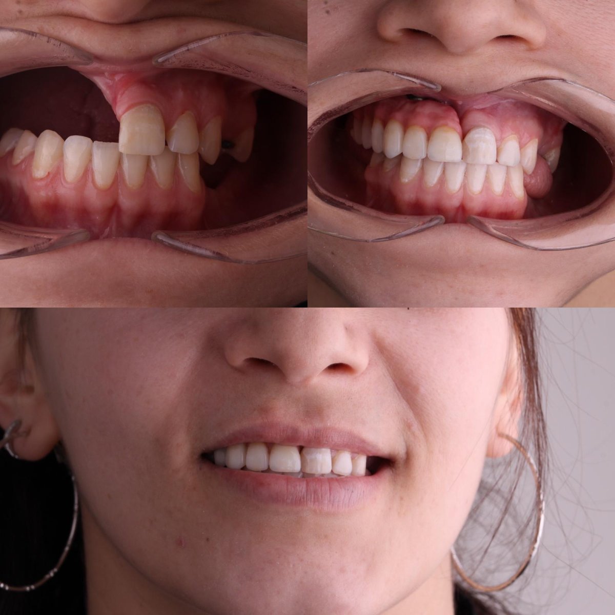 Resultados antes y después de implante de mandíbula en Dentavie Istanbul Dental Clinic, sonrisa mejorada
