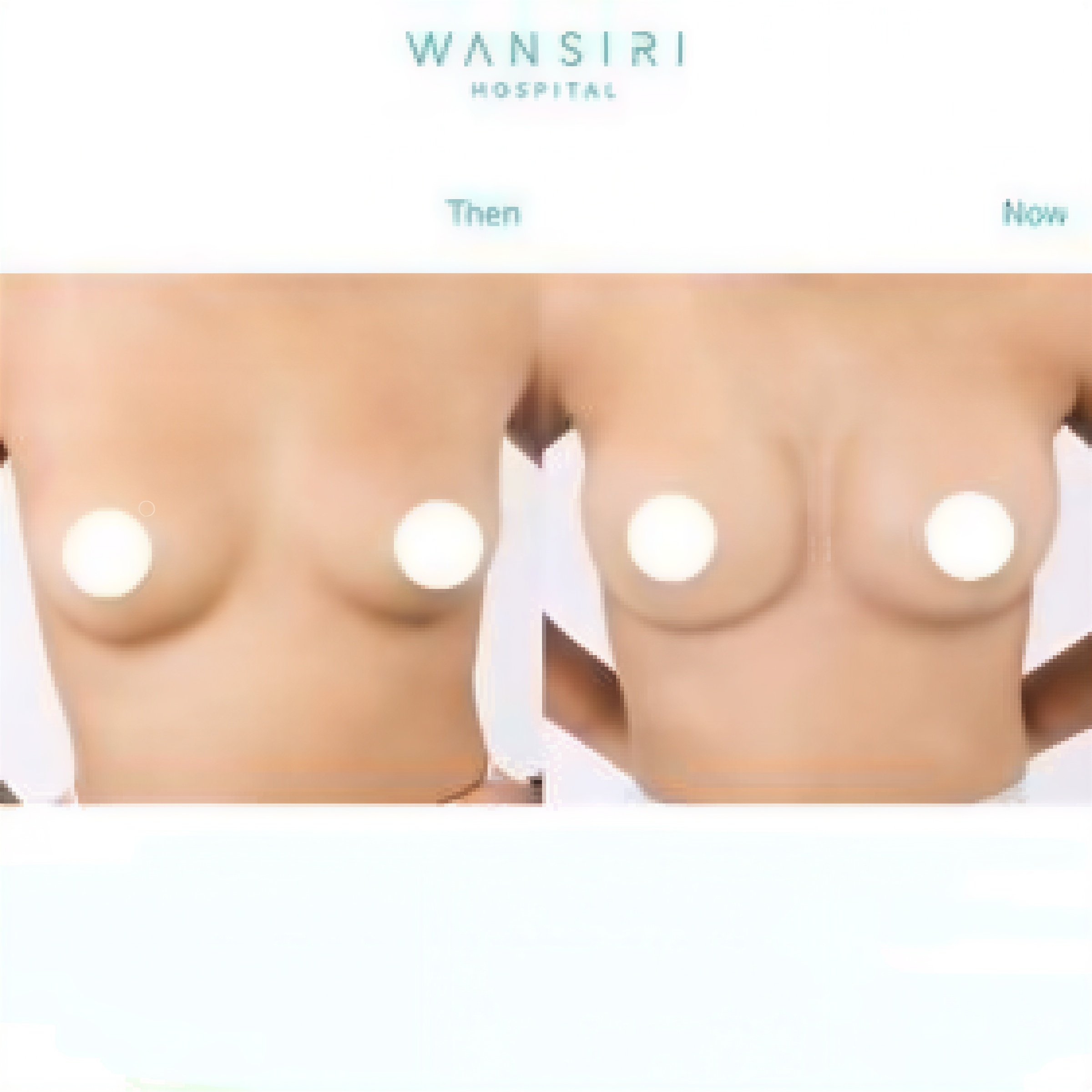 Resultados antes y después de aumento de senos con transferencia de grasa en Wansiri Hospital